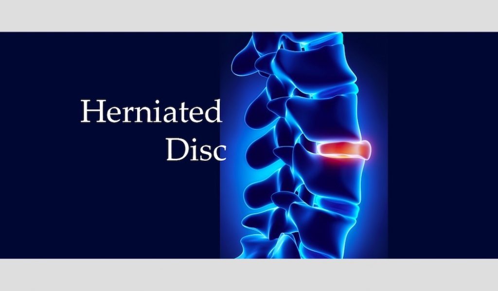 spinal hernia and erectile dysfunction