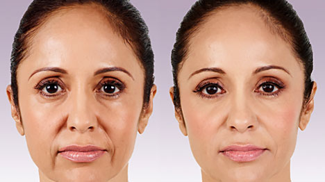 How Juvederm is an Effective and Aesthetic Treatment