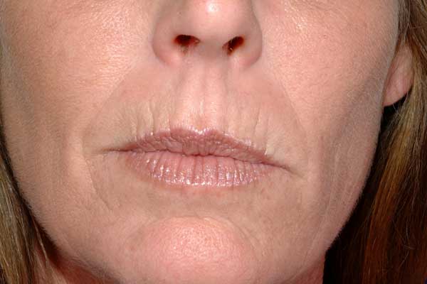 How Juvederm is an Effective and Aesthetic Treatment